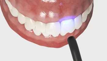 Teeth Bonding Procedure 101: Interesting Facts