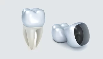 When Does the Need for a Dental Crown Arise?