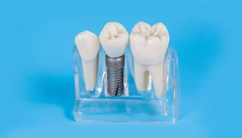 Dental Implants: Their Uses, Types, and Benefits