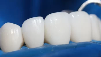 Types of Dental Bridges in Dentistry