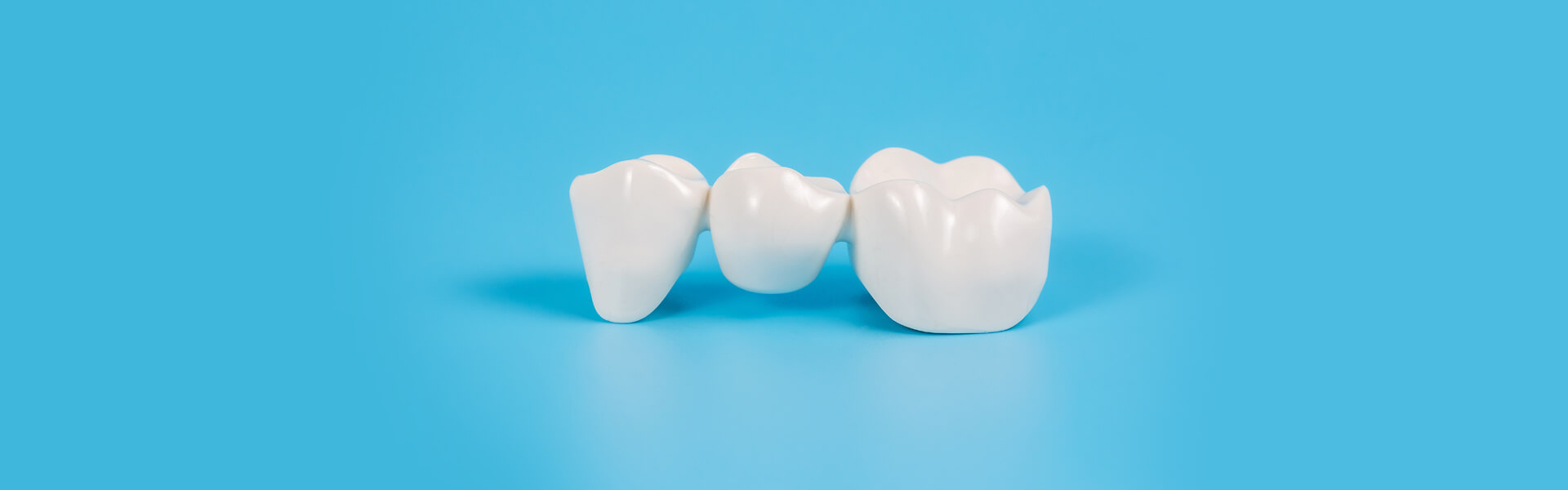 What are Dental Bridges and their Benefits?
