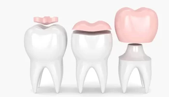 An Ultimate Guide About Dental Inlays & Onlays