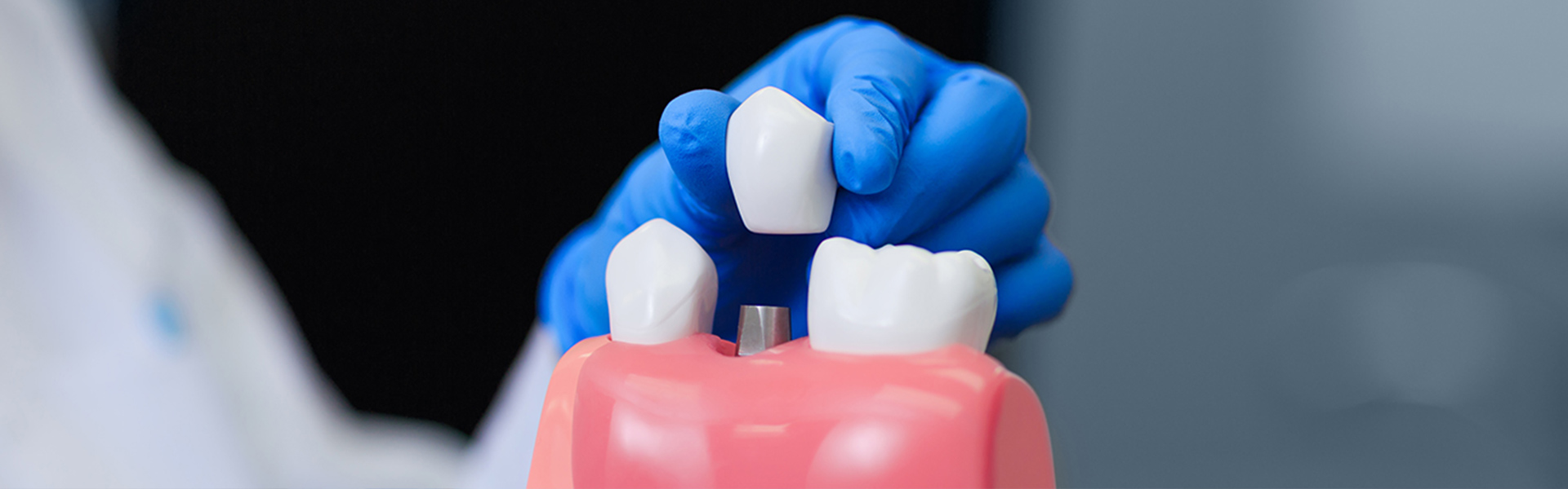What Are the Signs You Might Need Dental Implants?