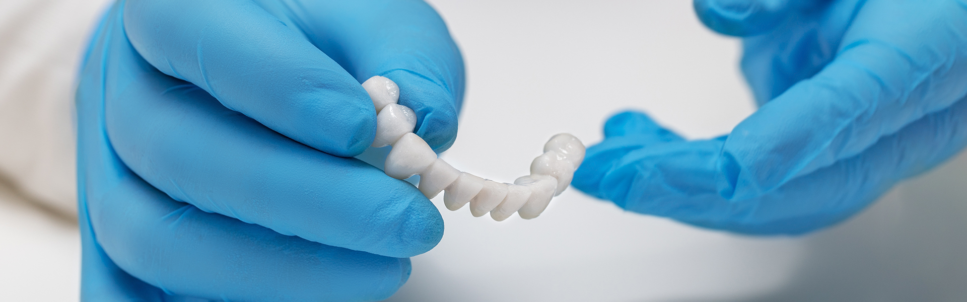 5 Things To Know Before Considering a Dental Bridge